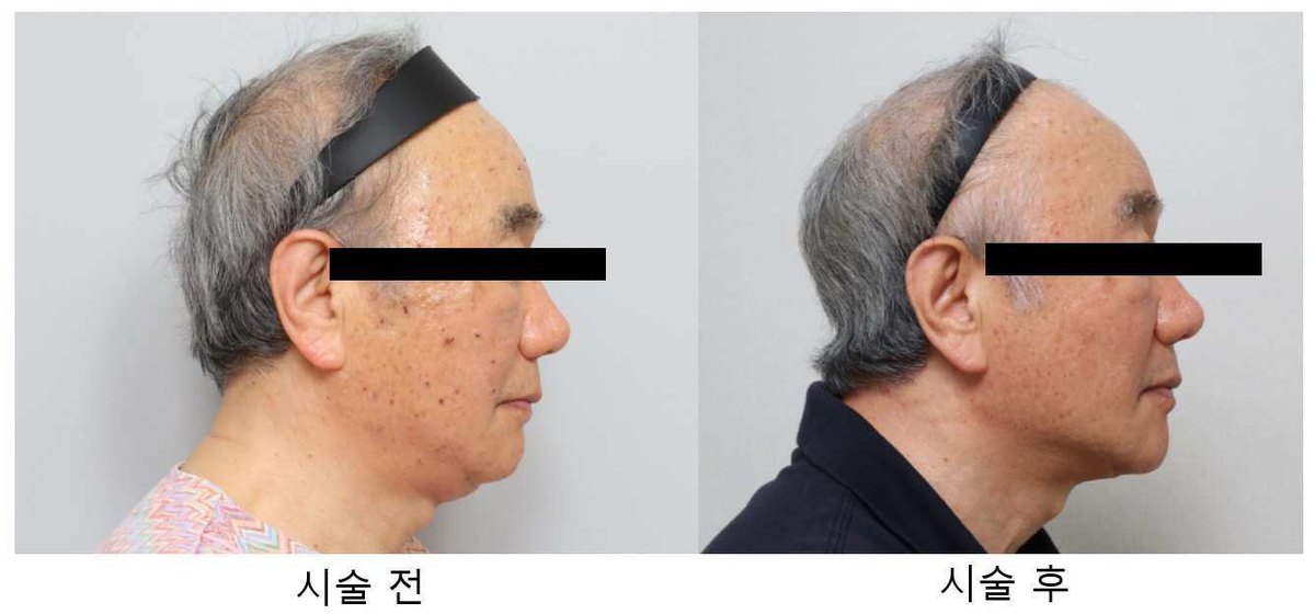 “지방분해용 주사제 조성물”의 도면